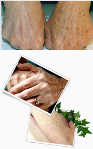 Effect of UV rays on skin